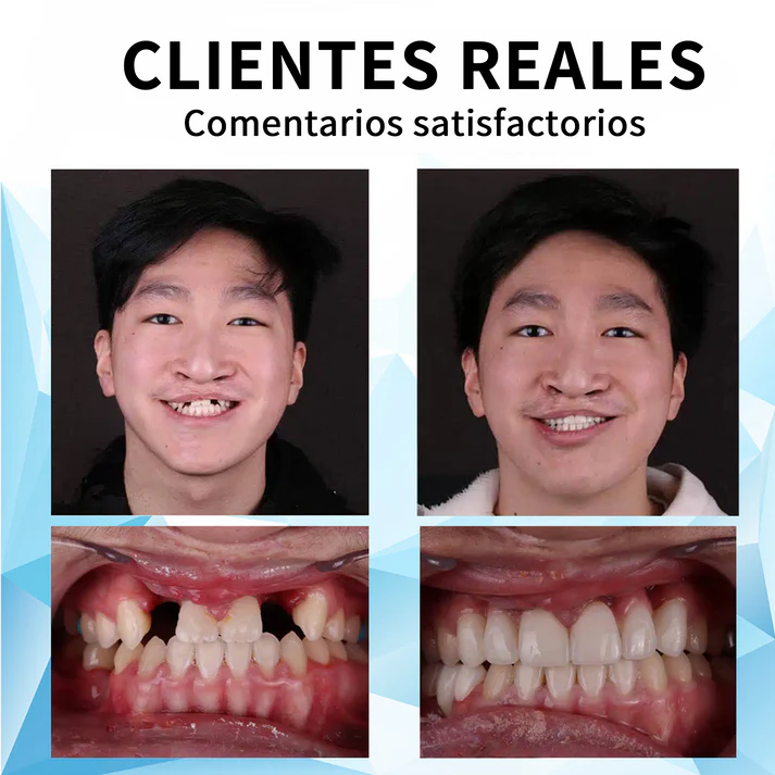 Sonrisa perfecta™ Prótesis de Silicona superior